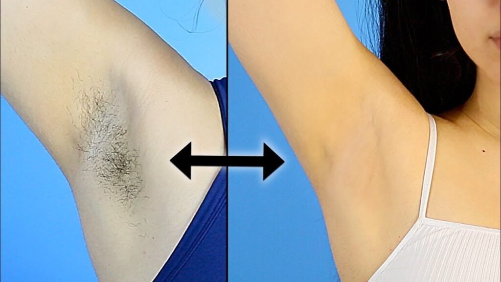 5 Effective Ways to Remove Underarm Hair at Home